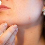 come evitare acne giovanili in viso
