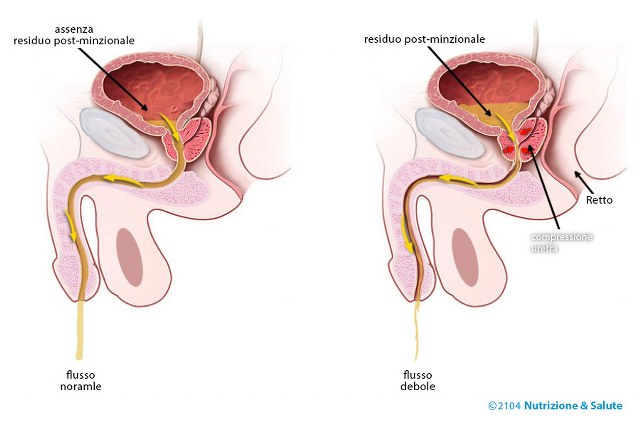 cibi da evitare per la prostata reteta de radacina rosie pentru prostatita